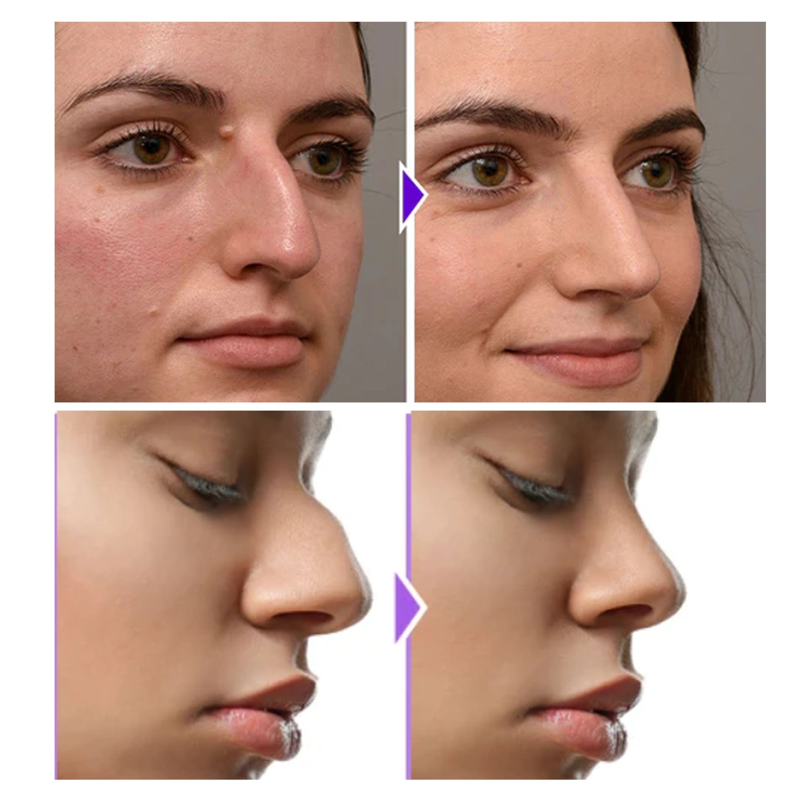 Nose Shaper | Easy-to-Use Nose Shape Enhancer