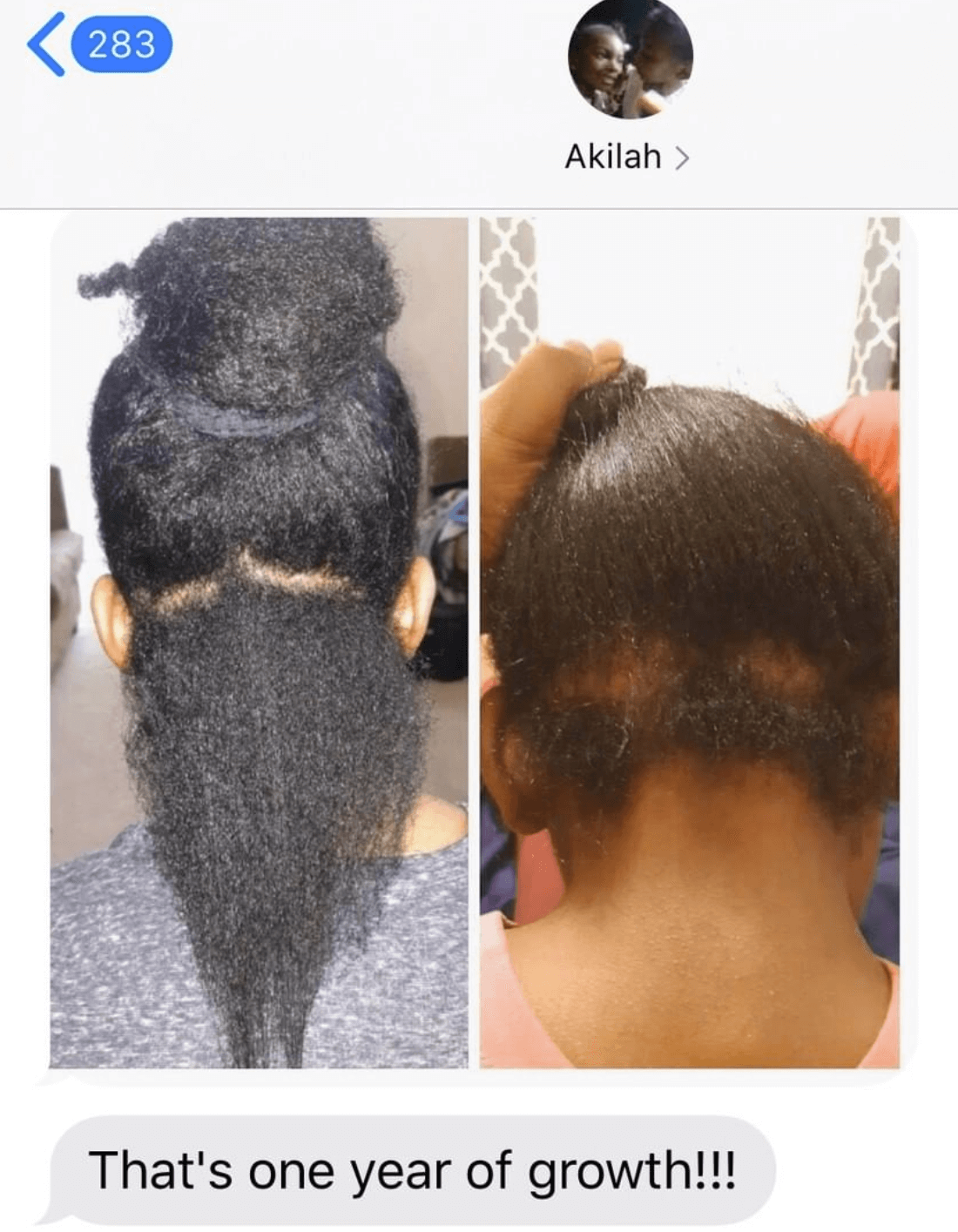 Two images showing a person's hair growth over one year, with text indicating 'That's one year of growth!!!'.