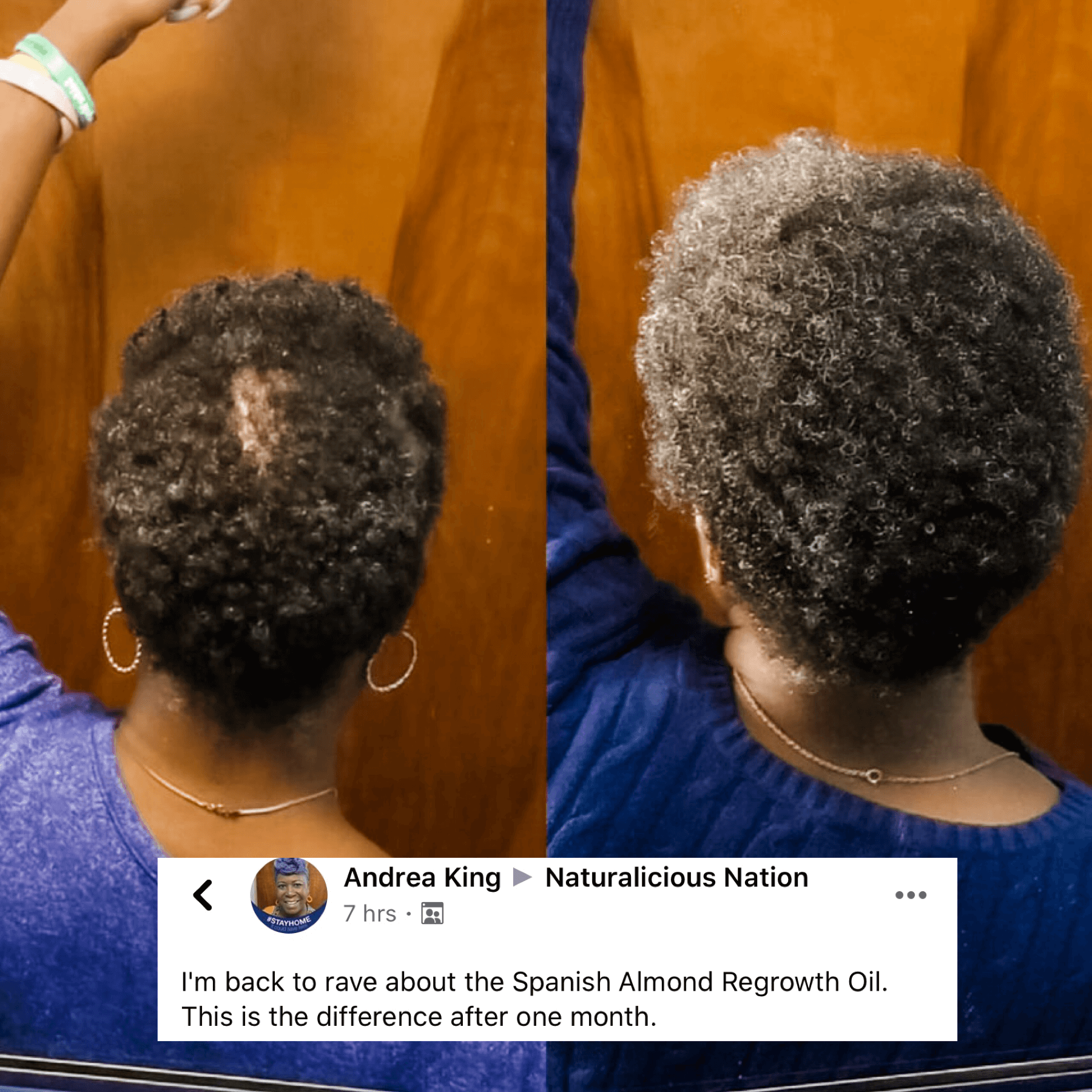 Before and after comparison of a person's hair growth with text overlay on a wooden background
