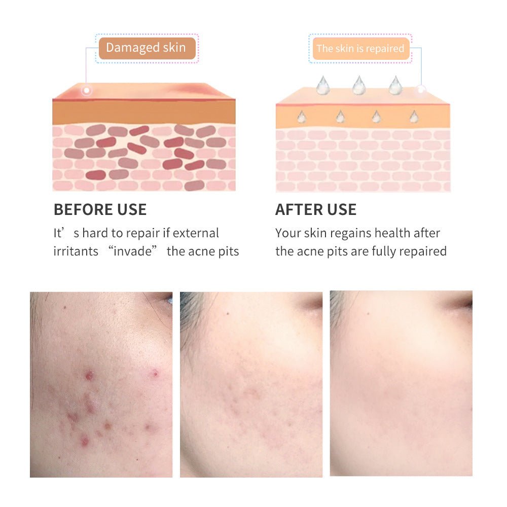Tea Tree Acne Scar Removal Gel – Fade Scars & Soothe Skin - HalleBeauty