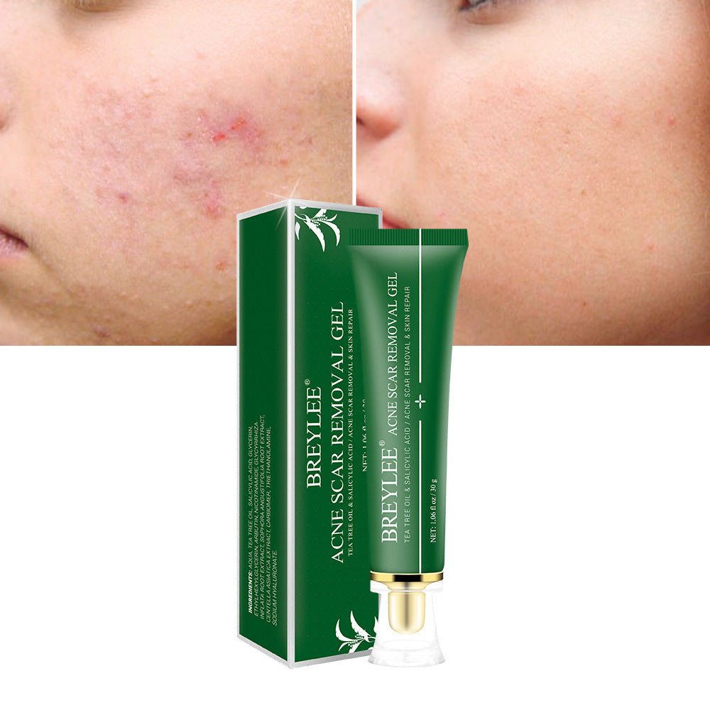 Tea Tree Acne Scar Removal Gel – Fade Scars & Soothe Skin - HalleBeauty